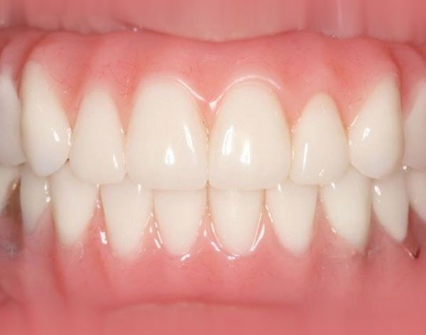 Denture Case Study Fort Worth Texas After Photo
