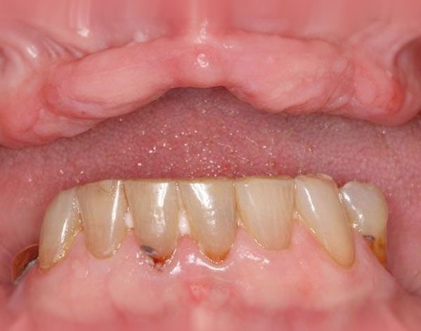 Denture Case Study Fort Worth Texas Before Photo
