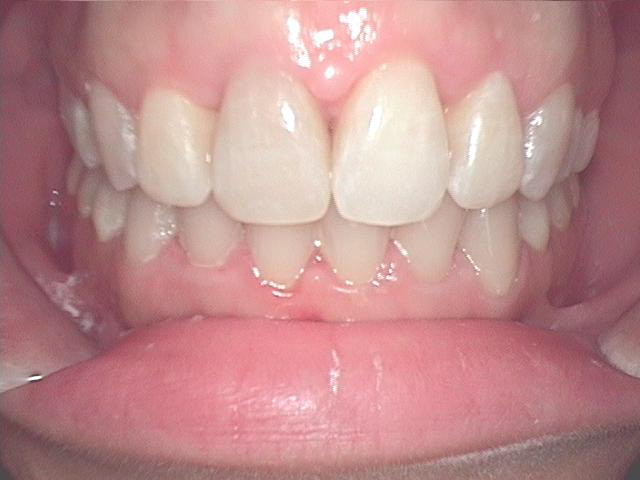 Invisalign in Fort Worth Keller Texas after a