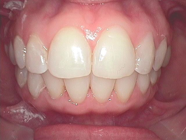 Invisalign in Fort Worth Keller Texas after c