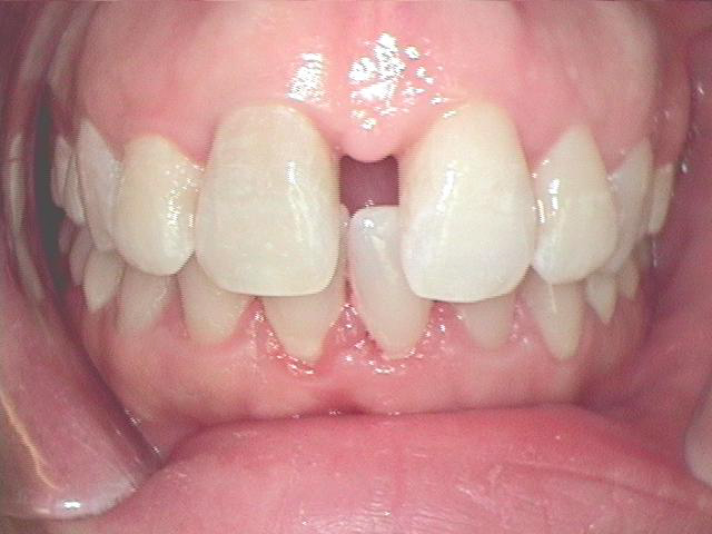 Invisalign in Fort Worth Keller Texas before a